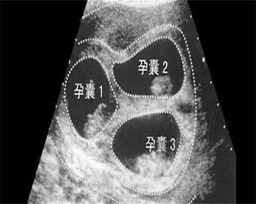 代怀包生儿子:贵州第三代试管婴儿医院排名是怎样的？附贵州试管医院费用和成功率